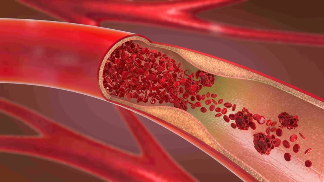 Zaburzenia hemostazy objawy – jak je rozpoznać i unikać powikłań